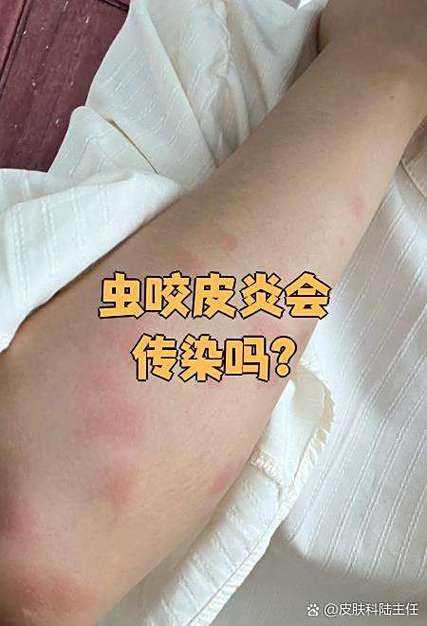 身上长虫子是什么病