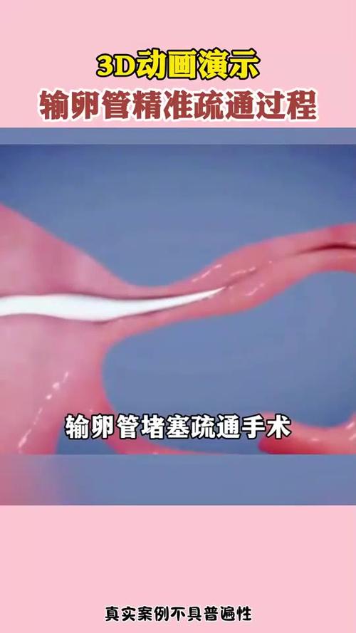 输卵管堵塞了怎么疏通
