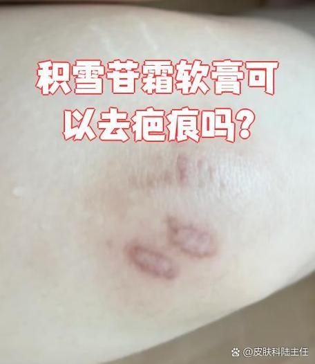 去疤痕最有效果的药膏