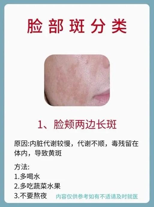 脸上的雀斑怎样去掉(永久的去掉)