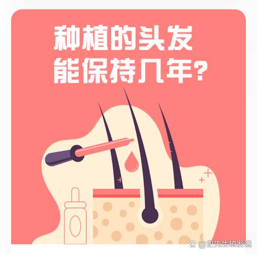 植发后可以维持几年
