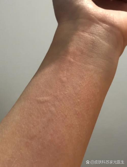 全身发痒一挠就起疙瘩