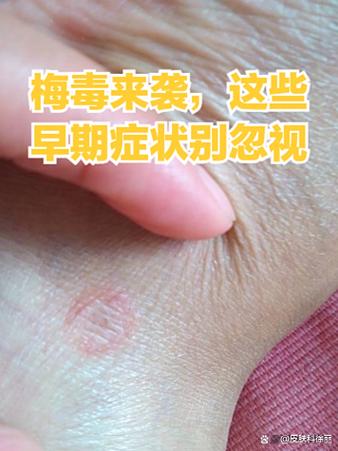 男士梅毒的10个征兆