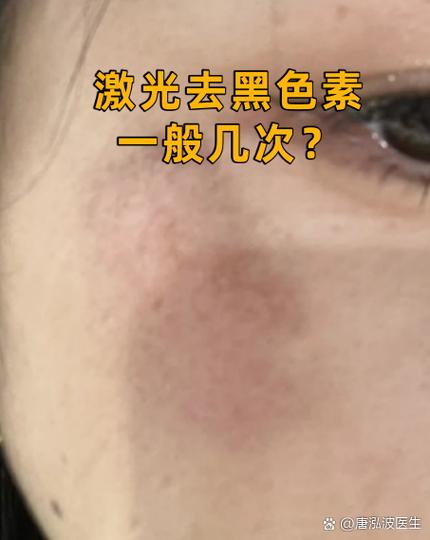 去除黑色素沉淀的方法截图3