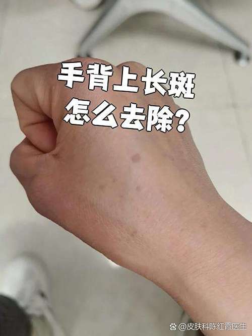 怎样去斑点小窍门有效