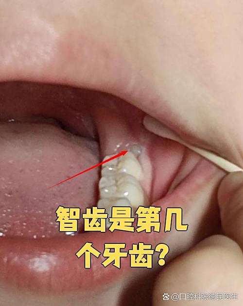 智齿是哪个牙齿