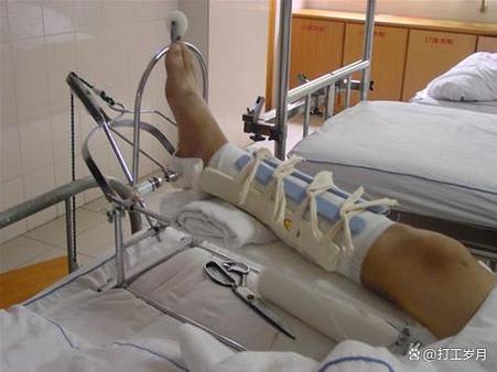 腓骨取钢板几天能脱拐