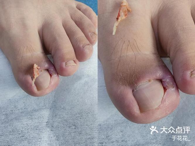 修脚师傅怎么治甲沟炎