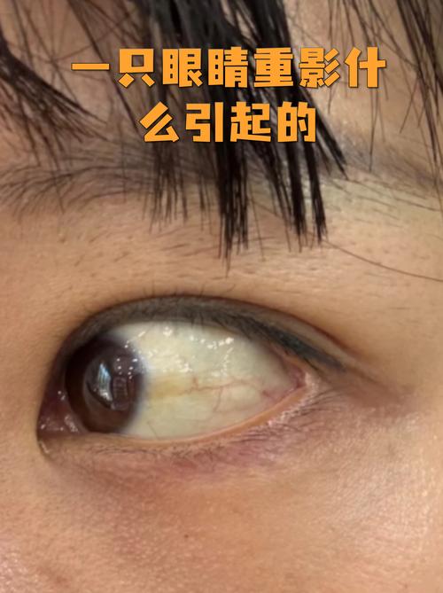 眼睛看文字有重影是什么问题