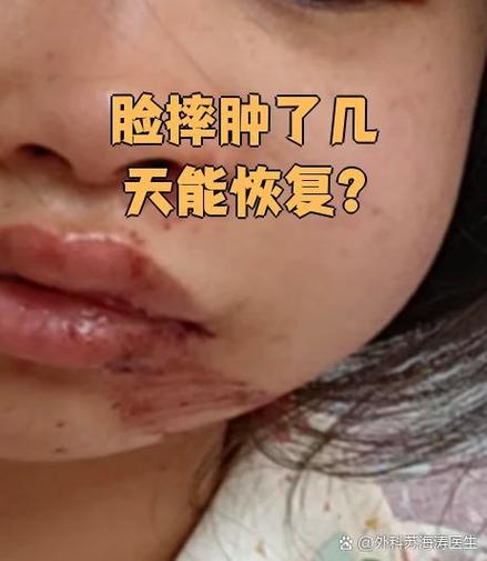 脸摔肿了第几天最严重
