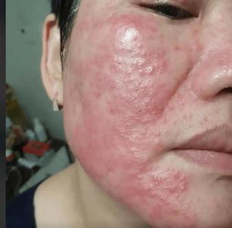 脸部季节性过敏痒怎么办