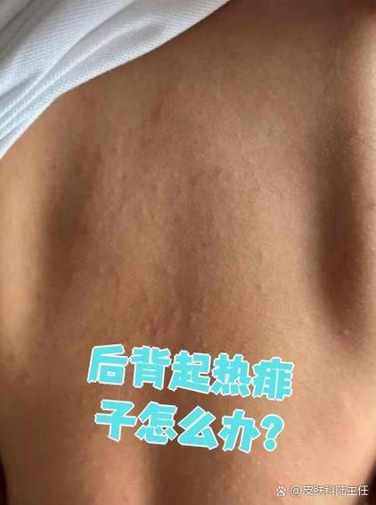后背发热和哪些病有关截图3