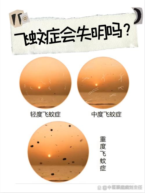 飞蚊症的黑影能消除吗