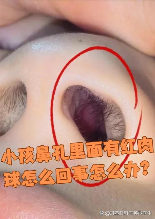 鼻孔内壁结痂要警惕了