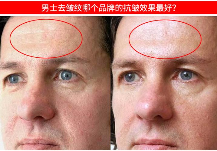 男士去皱纹用什么好