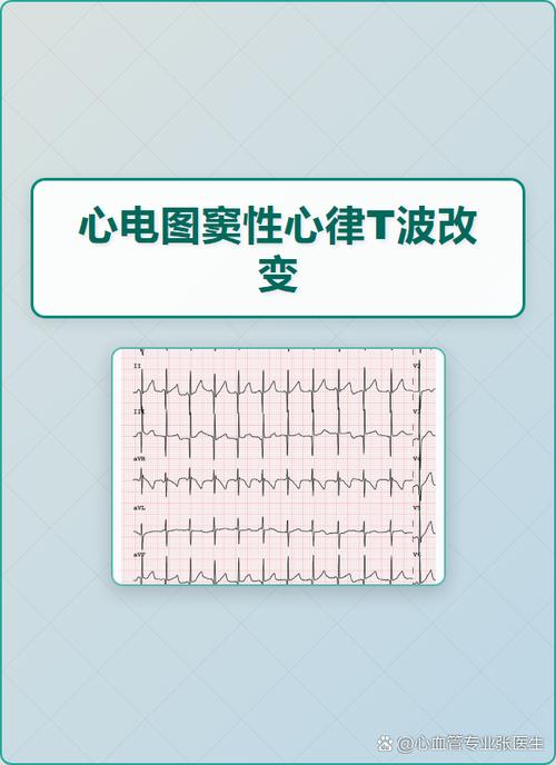 窦性心律t波改变严重吗