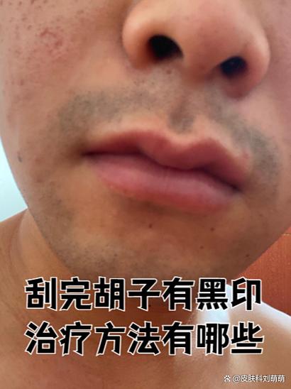 膏药留下的黑印怎么去除