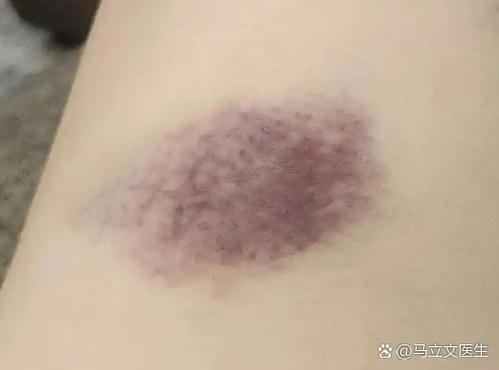 一觉醒来手上有铁锈色印记