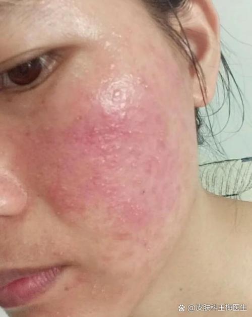 脸上有红斑还起皮屑