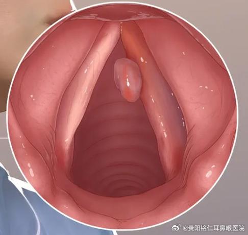 声带坏了最明显的征兆