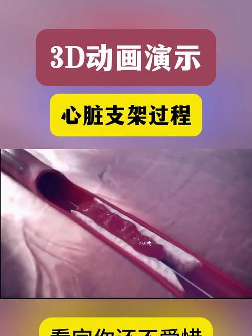 心脏支架怕震动吗