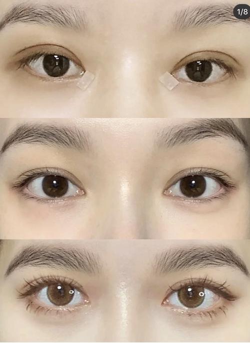7mm双眼皮恢复后剩下多少