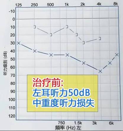 耳朵听力变大像有扩音器似的
