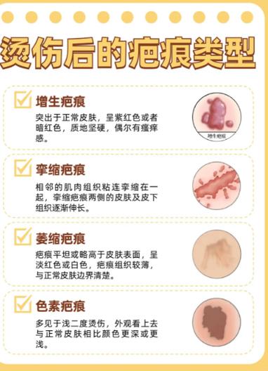 烧伤疤痕怎么能彻底消除