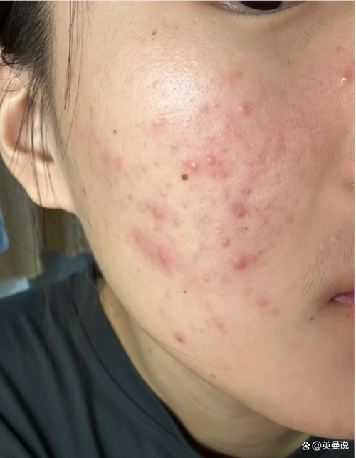 脸上痘印怎么去除最有效的方法