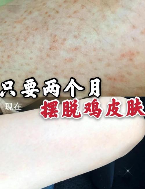 鸡皮怎么去除最有效