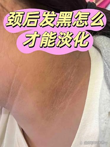 皮肤黑色素怎么消除