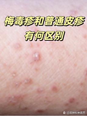 腋窝下梅毒疹图片