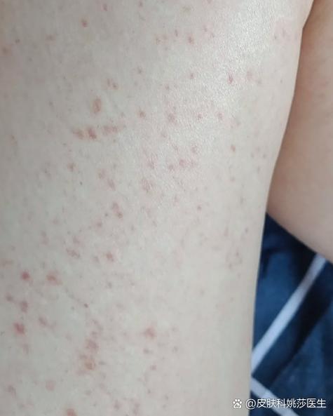 腿上起了小红点不疼不痒