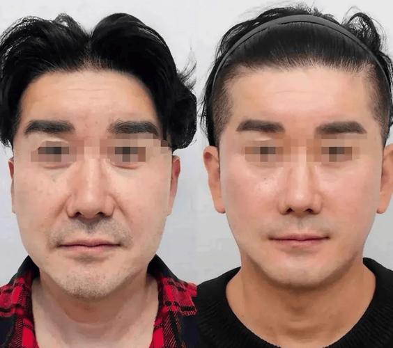 男士脸部皮肤松弛有什么办法紧致
