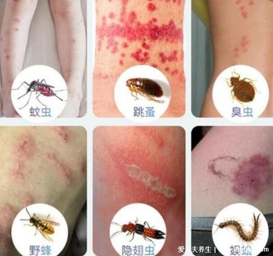 床上虫子咬人起疙瘩什么虫