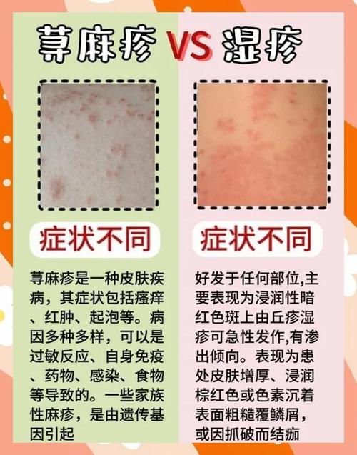 皮肤荨麻疹怎么治疗能除根