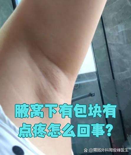 腋窝有鼓包软的不痛不痒