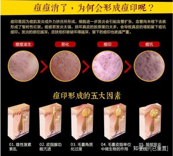 脸上的黑色痘印应该怎样去除