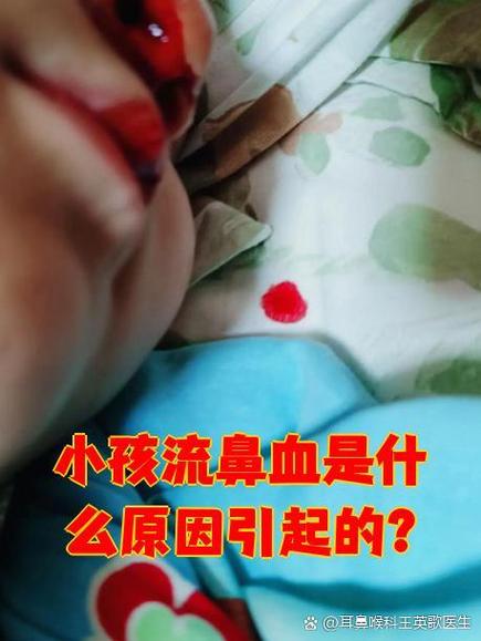 宝宝偶尔流鼻血要紧吗截图3