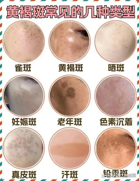 晒斑怎么去除掉