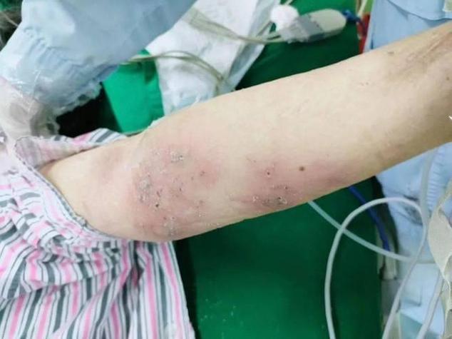 被鼹鼠咬了怎么办
