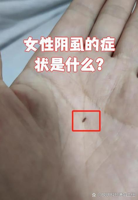 阴虱是怎么引起的