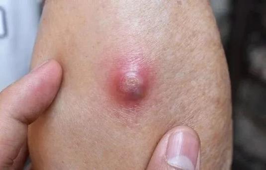 豆豆挤掉后肿个大红包