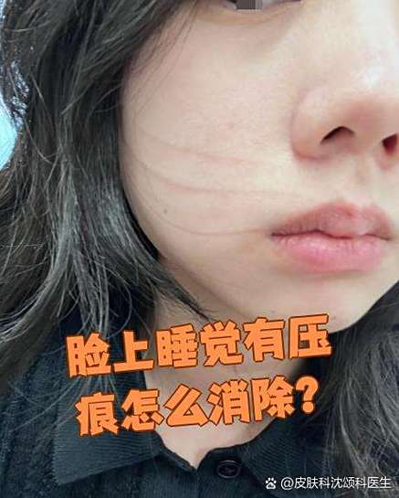 脸上被压的痕迹如何快速消除