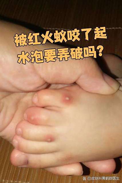 被红蚂蚁咬了怎么办