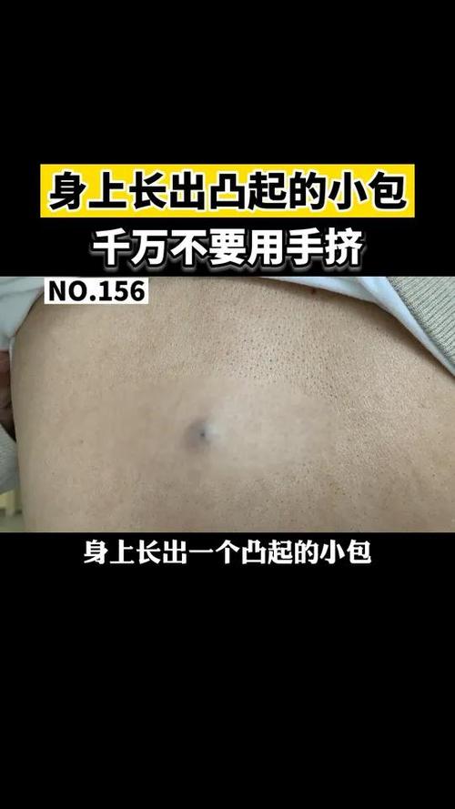 身上黑色点点越来越多是怎么回事