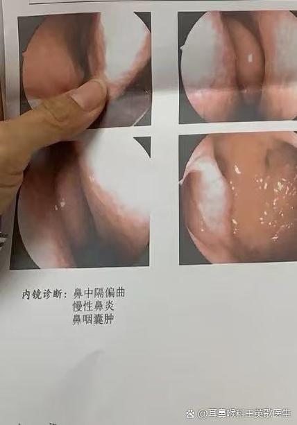 小孩经常流鼻血是怎么回事