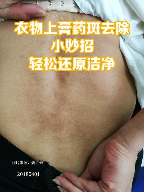 身上沾了膏药怎么去除