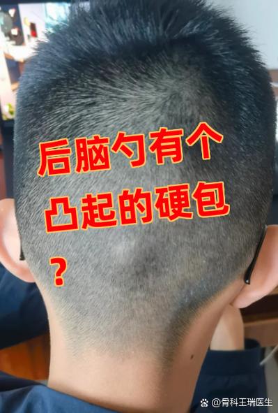 头后面长了个骨头凸起