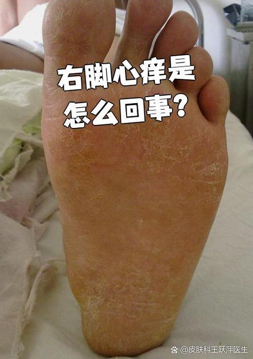 脚底钻心痒要警惕四种病